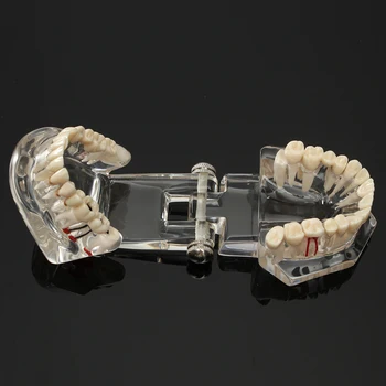 Dantų Implantai Dantų Ligos Modelis Su Restauravimo Tiltas Danties Modelis Odontologijos Mokymo Priemones, Stomatologas, Medicinos Medžiagos