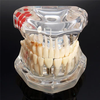 Dantų Implantai Dantų Ligos Modelis Su Restauravimo Tiltas Danties Modelis Odontologijos Mokymo Priemones, Stomatologas, Medicinos Medžiagos